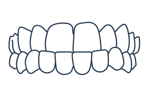 Underbite example for Invisalign